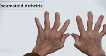 Rheumatoid Arthritis Causes, Symptoms, Signs