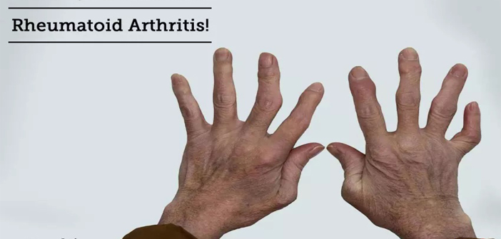 Rheumatoid Arthritis Causes, Symptoms, Signs